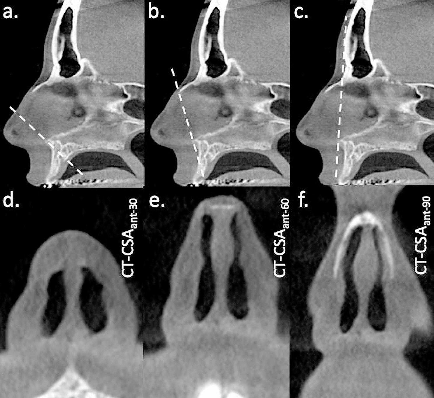 CT comparison of the nasal airway anterior and posterior to the piriform aperture in patients with and without nasal obstruction