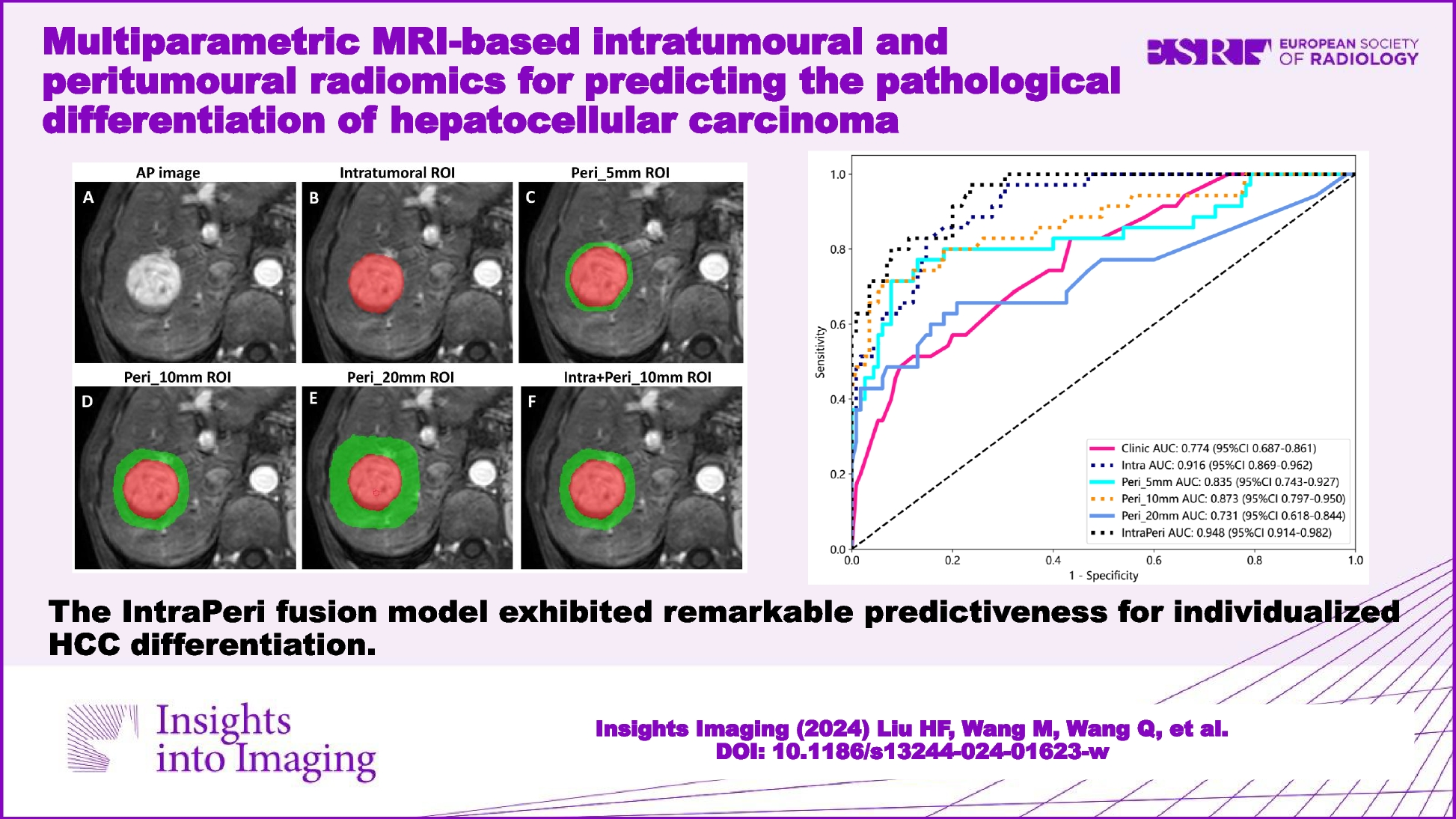 Multiparametric MRI-based intratumoral and peritumoral radiomics for predicting the pathological differentiation of hepatocellular carcinoma