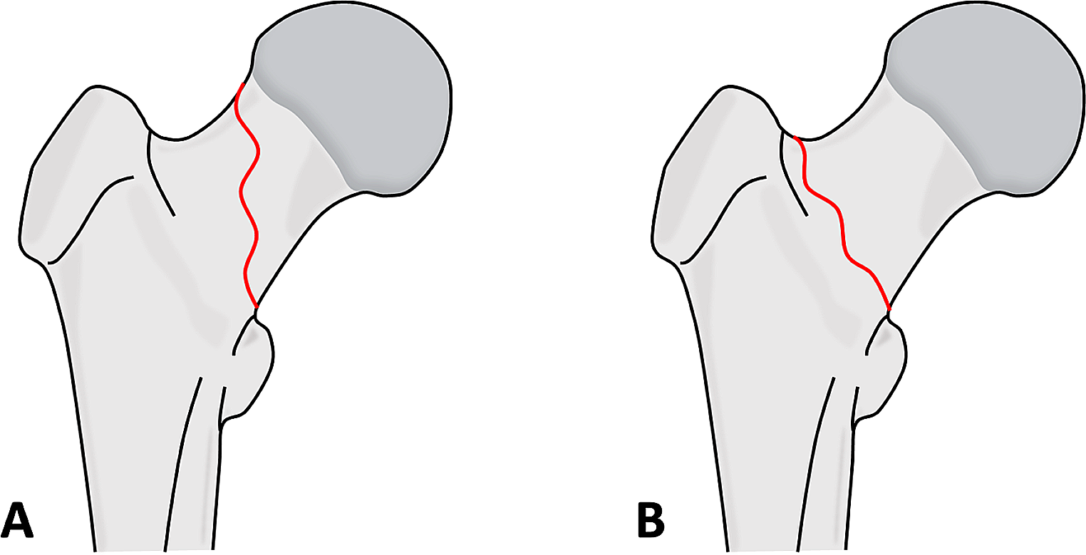 MRI characteristics of radiographically occult femoral neck fractures in trauma patients with ipsilateral femoral shaft fractures
