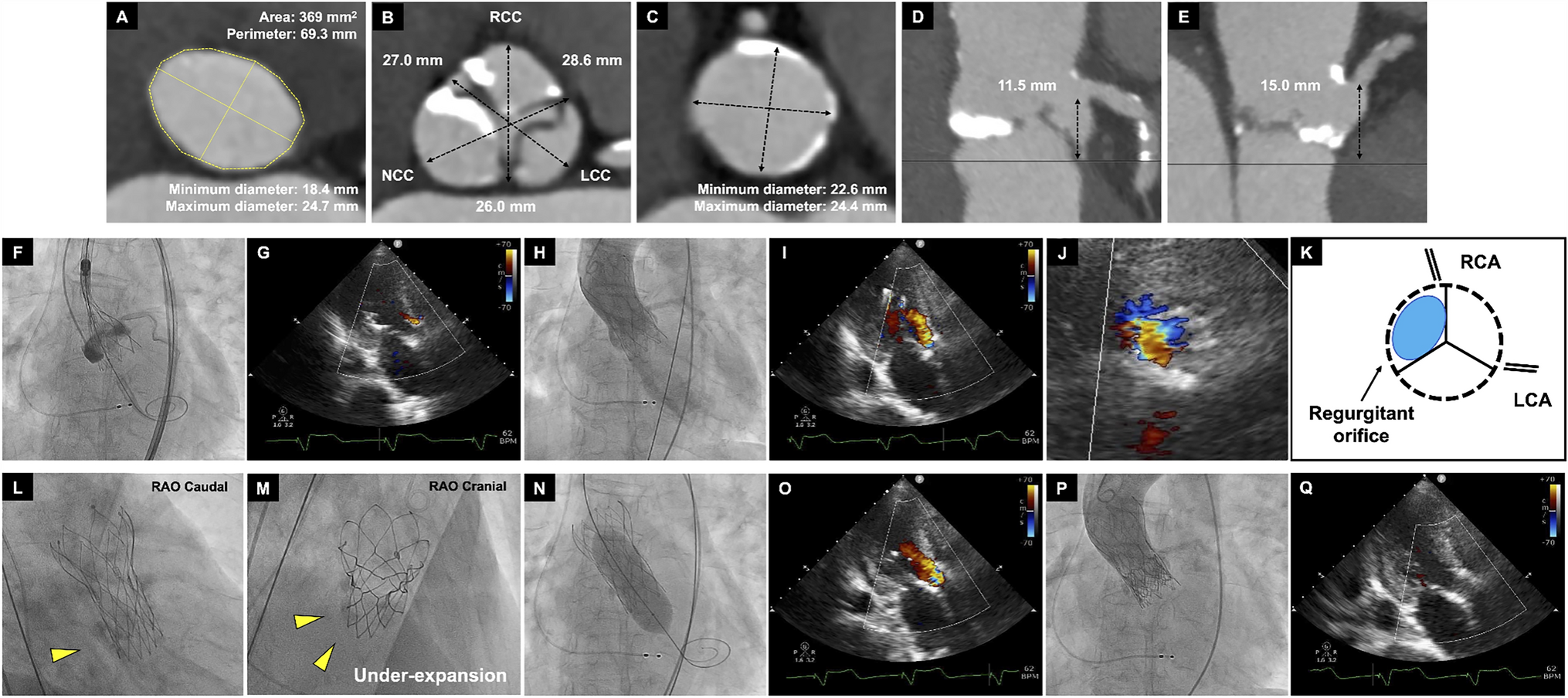 Acute leaflet malfunction of Navitor valve with severe intraprosthetic aortic insufficiency immediately after implantation