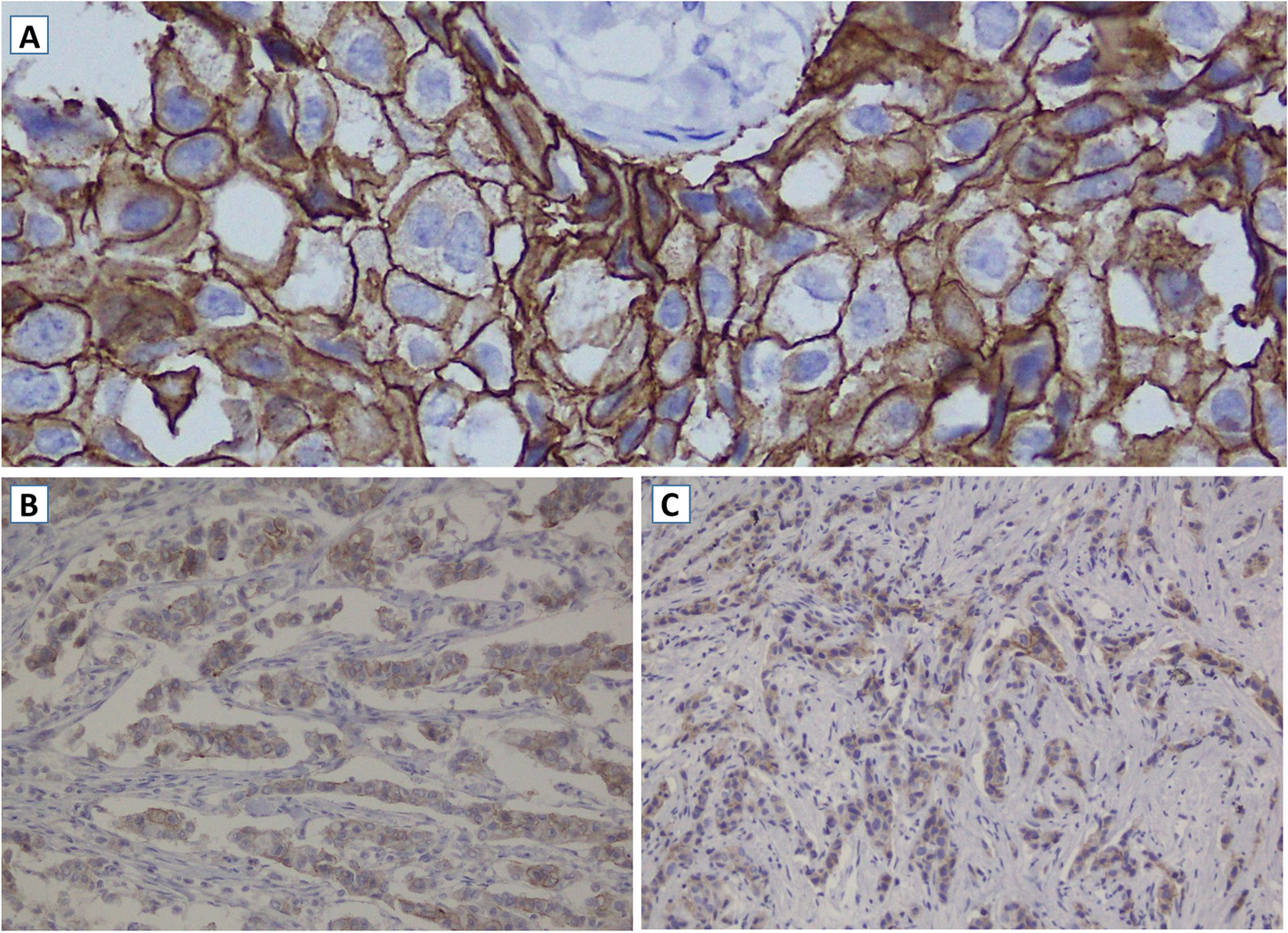 Association of hormone receptors and human epidermal growth factor receptor-2/neu expressions with clinicopathologic factors of breast carcinoma: a cross-sectional study in a tertiary care hospital, Kabul, Afghanistan