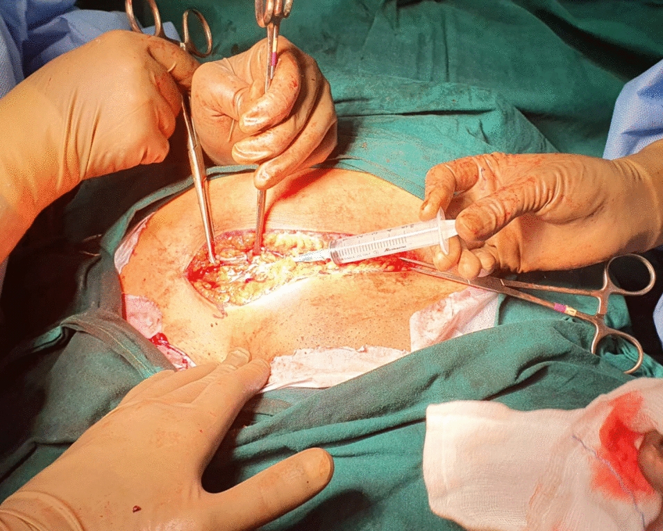 Evaluation of Bupivacaine Injection Instillation Directly in the Rectus Sheath in LSCS Cases as an Effective Analgesia Method