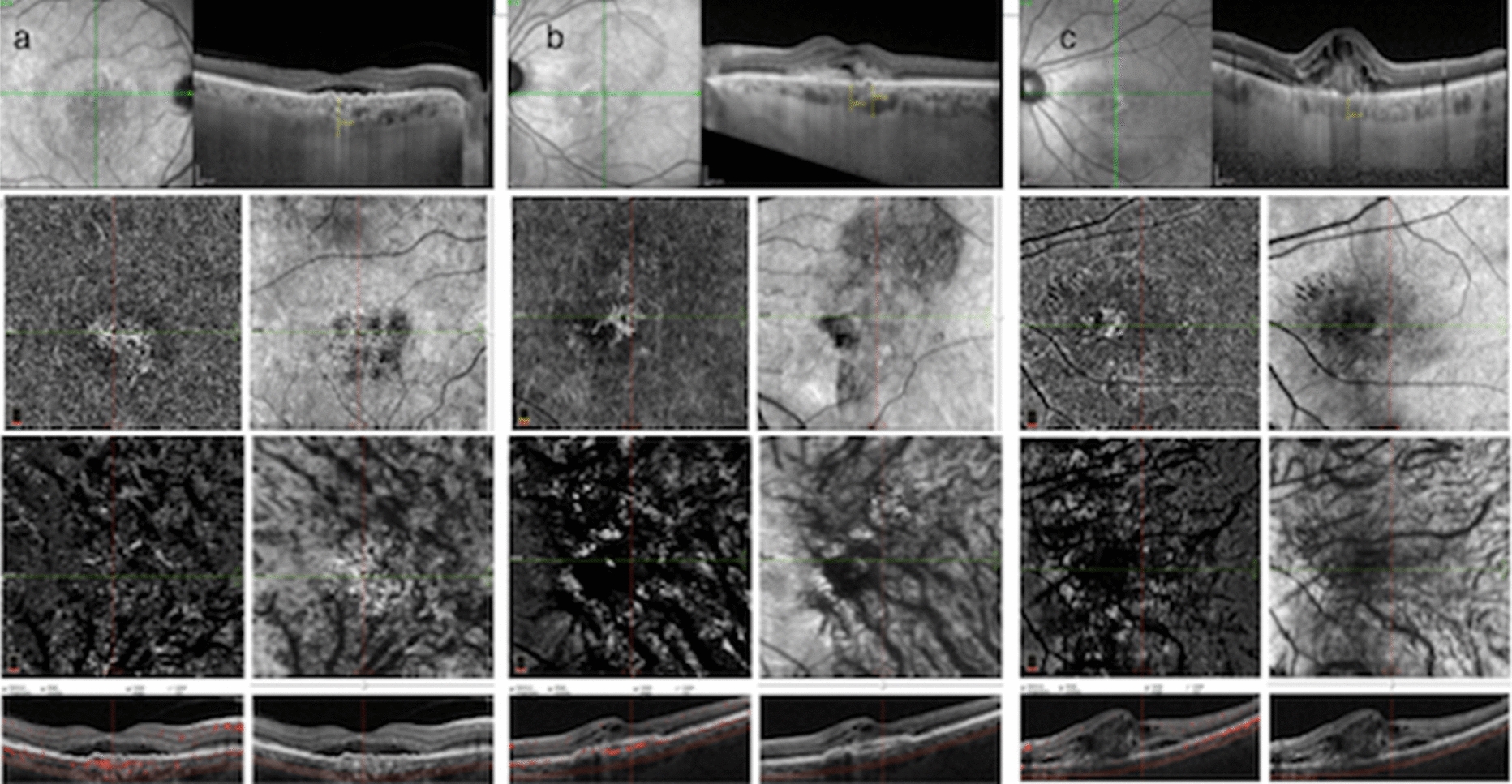 Pro re nata anti-VEGF treatment in pachychoroid neovasculopathy compared with age-related macular degeneration based on optical coherence tomography