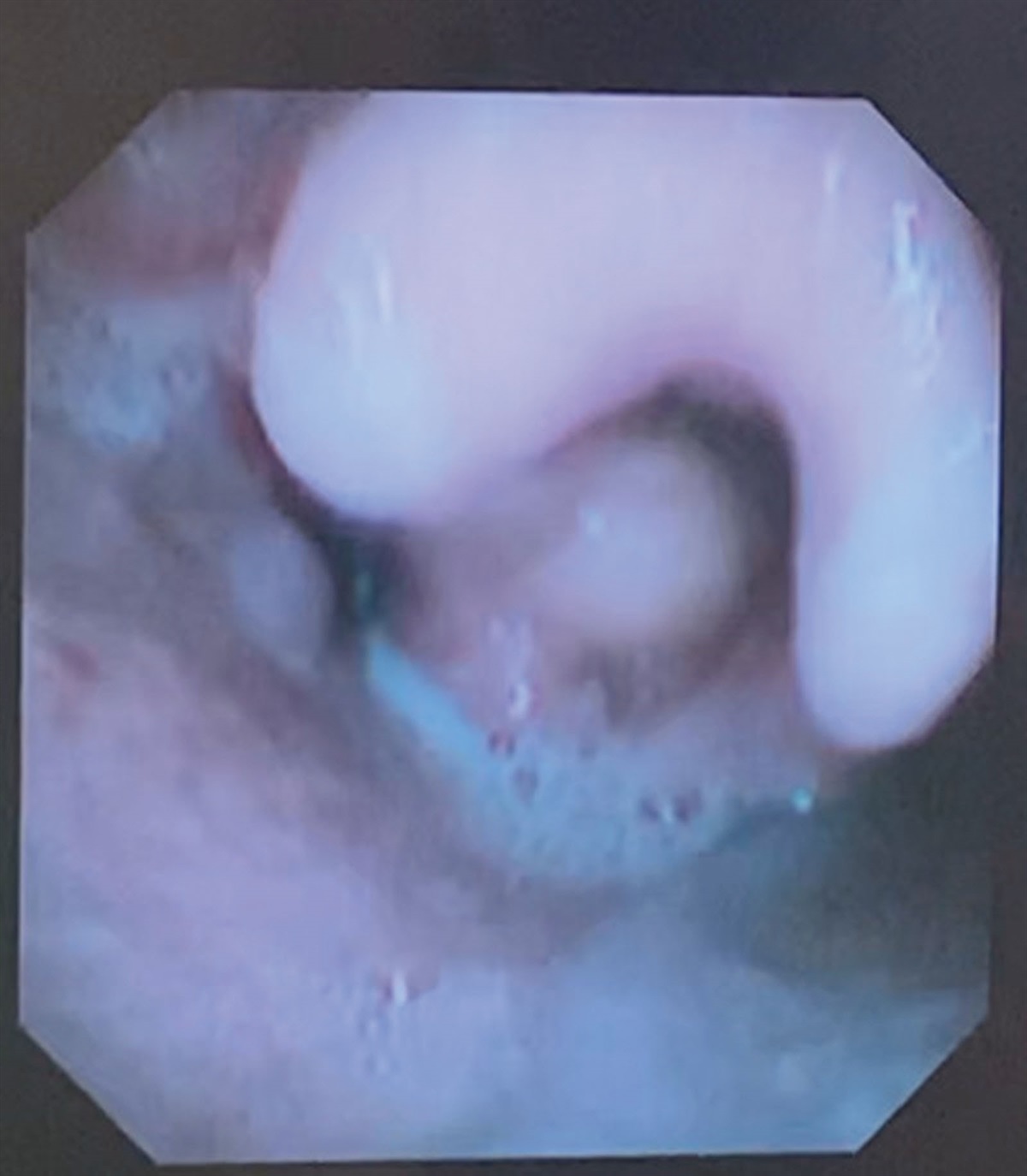 Aryepiglottic Cyst Developed Hours After Tracheal Intubation Causing Acute Upper Airway Ball-Valve Obstruction: A Case Report