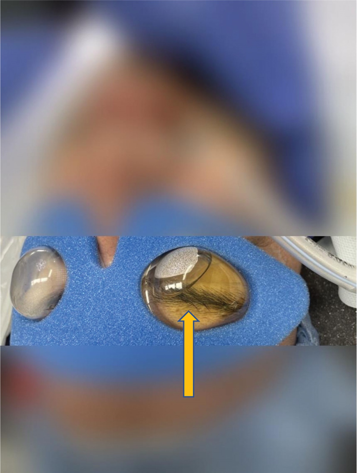 Retrograde Flow of Fluid Through the Nasolacrimal Duct System Under General Anesthesia: A Case Report