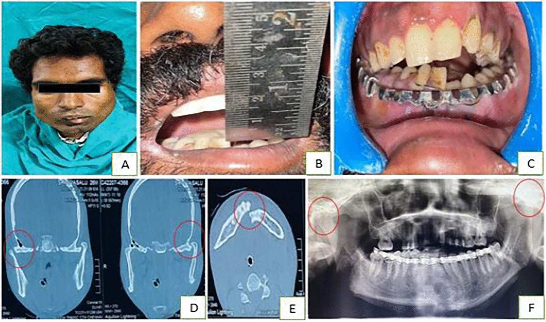 Bilateral Superolateral Dislocation of Intact Mandibular Condyle with Concomitant Symphysis Fracture: A Case Report