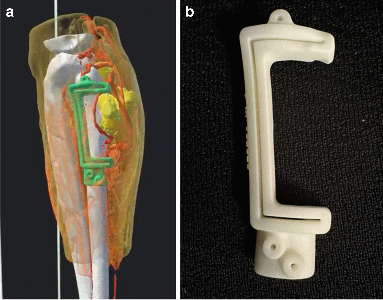 Multimodal virtual pre-operative planning for osteochondroma resection