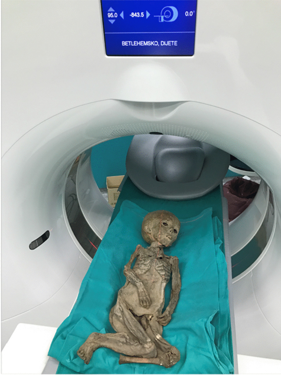 CT, MR, and isotope data of a mummified child from Zagreb Cathedral, Croatia: giving voice to the past through imaging