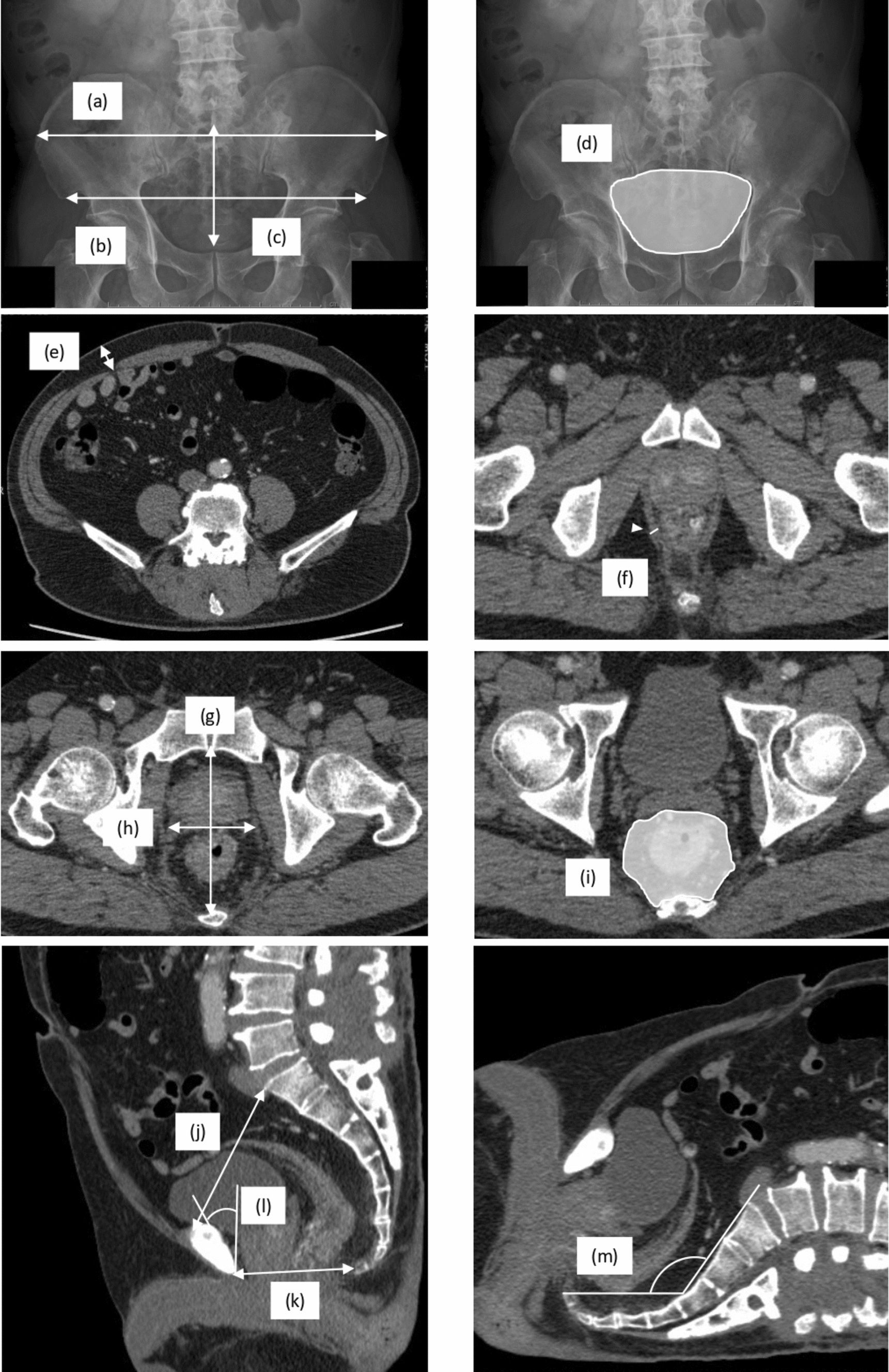 Simple pelvimetry predicts the pelvic manipulation time in robot-assisted low and ultra-low anterior resection for rectal cancer