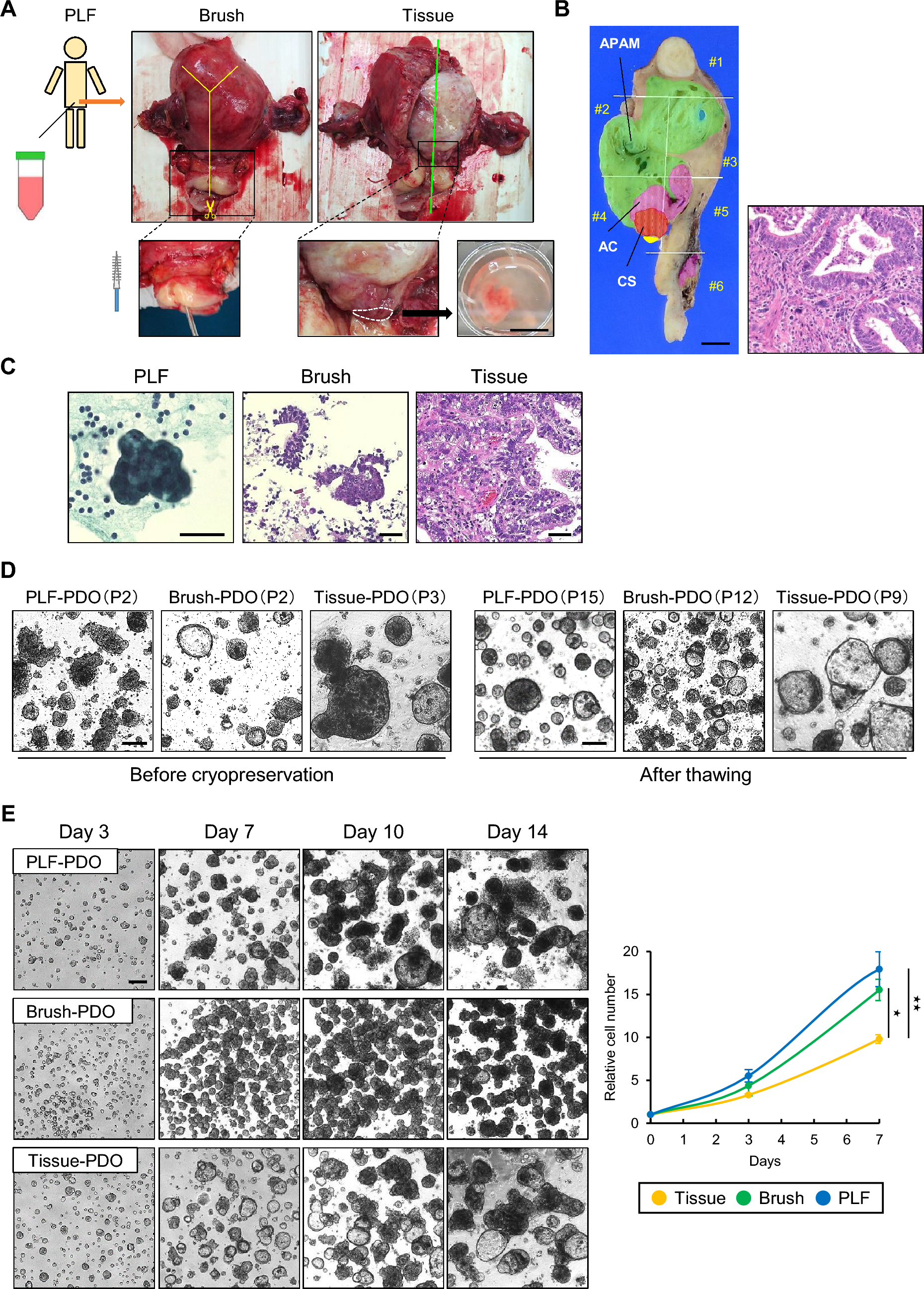 Establishment and characterization of multiple patient-derived organoids from a case of advanced endometrial cancer