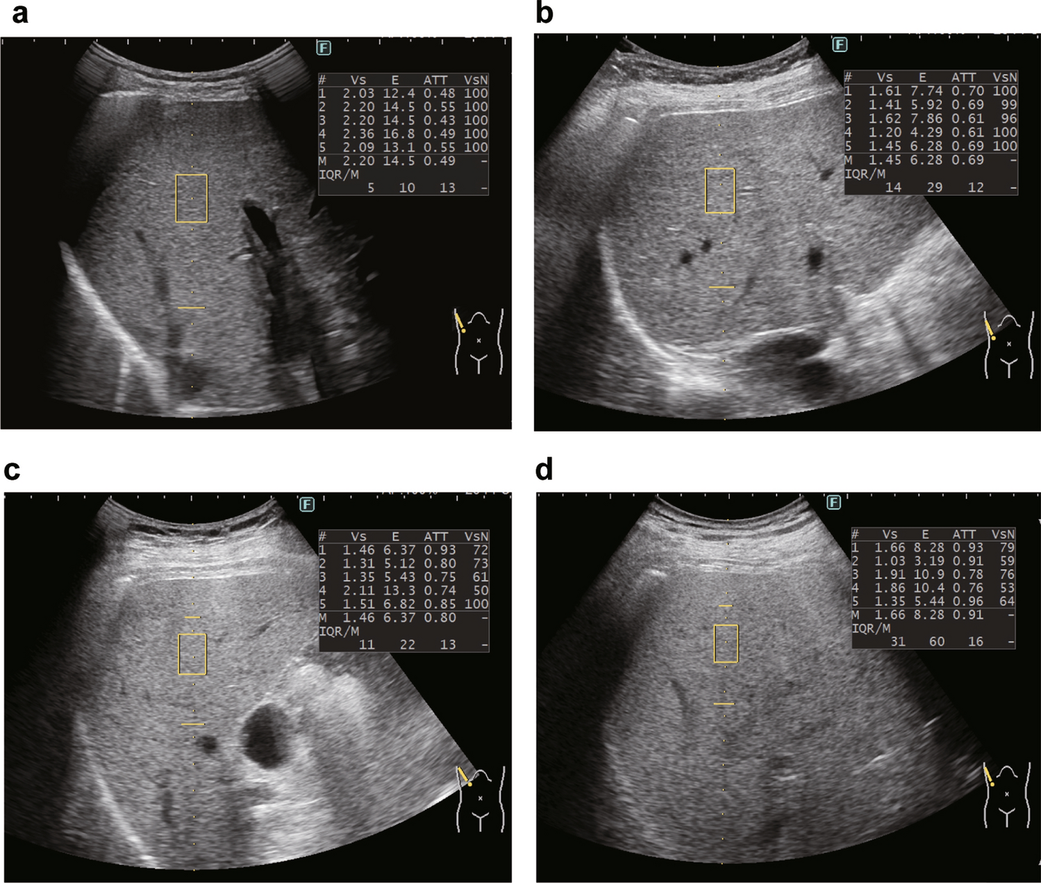 iATT liver fat quantification for steatosis grading by referring to MRI proton density fat fraction: a multicenter study