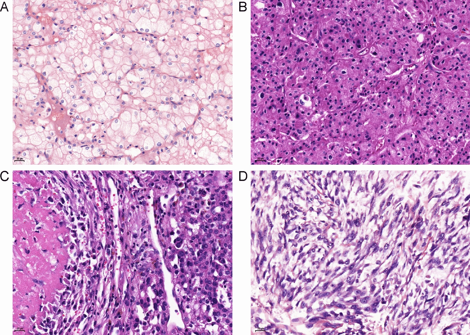 External validation of a four-tiered grading system for chromophobe renal cell carcinoma
