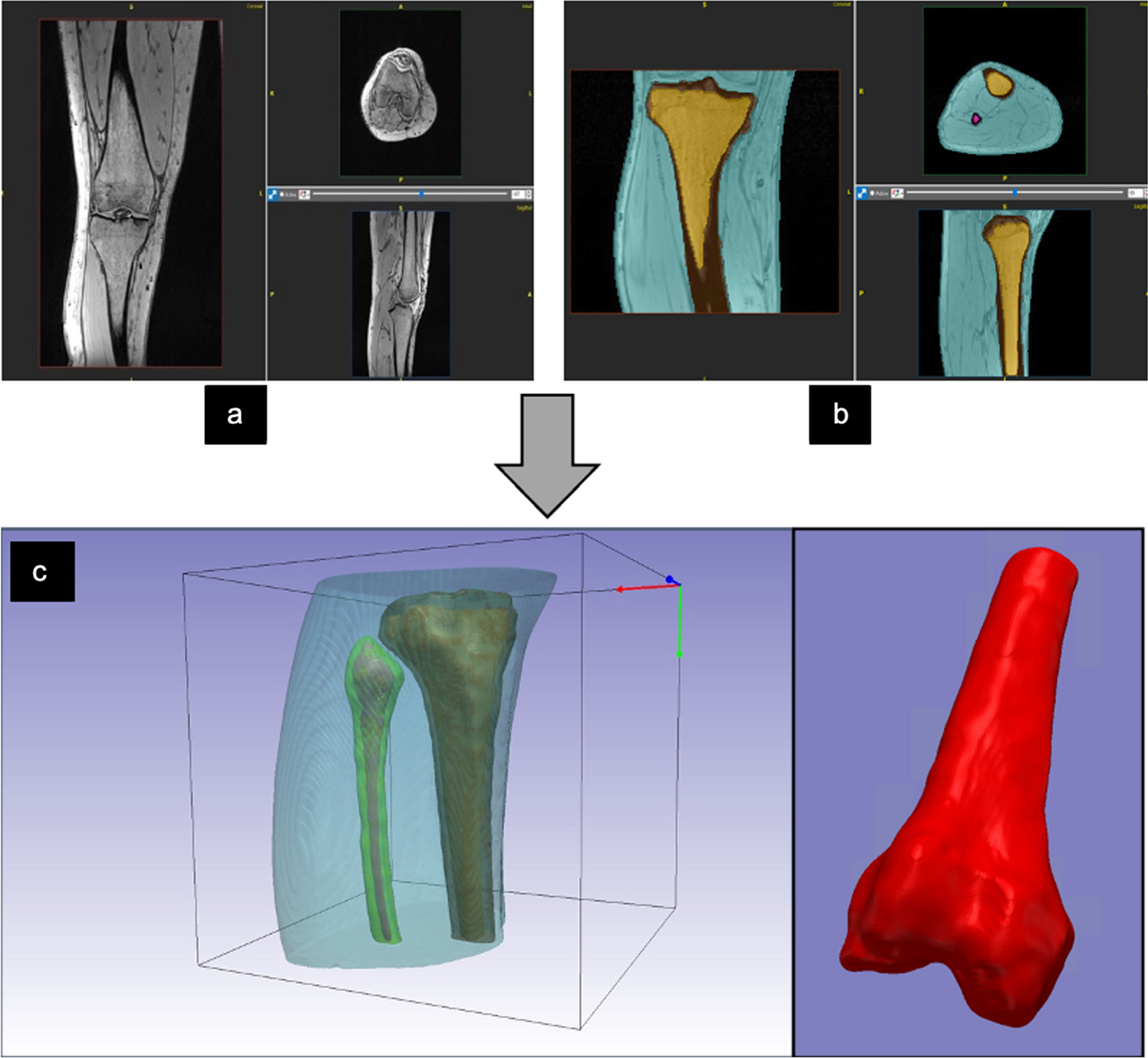 Optimising total knee replacement imaging: a novel 3D printed PET/CT anthropomorphic phantom for metal artefact simulation