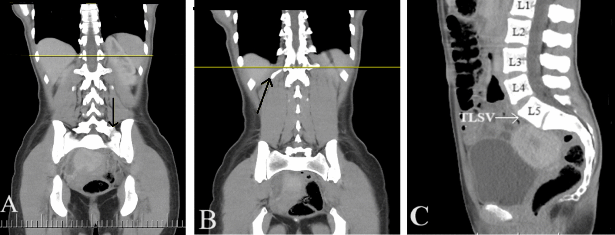 A simple method for the selection of valid spinopelvic parameters and lumbar lordosis in patients with transitional lumbosacral vertebrae