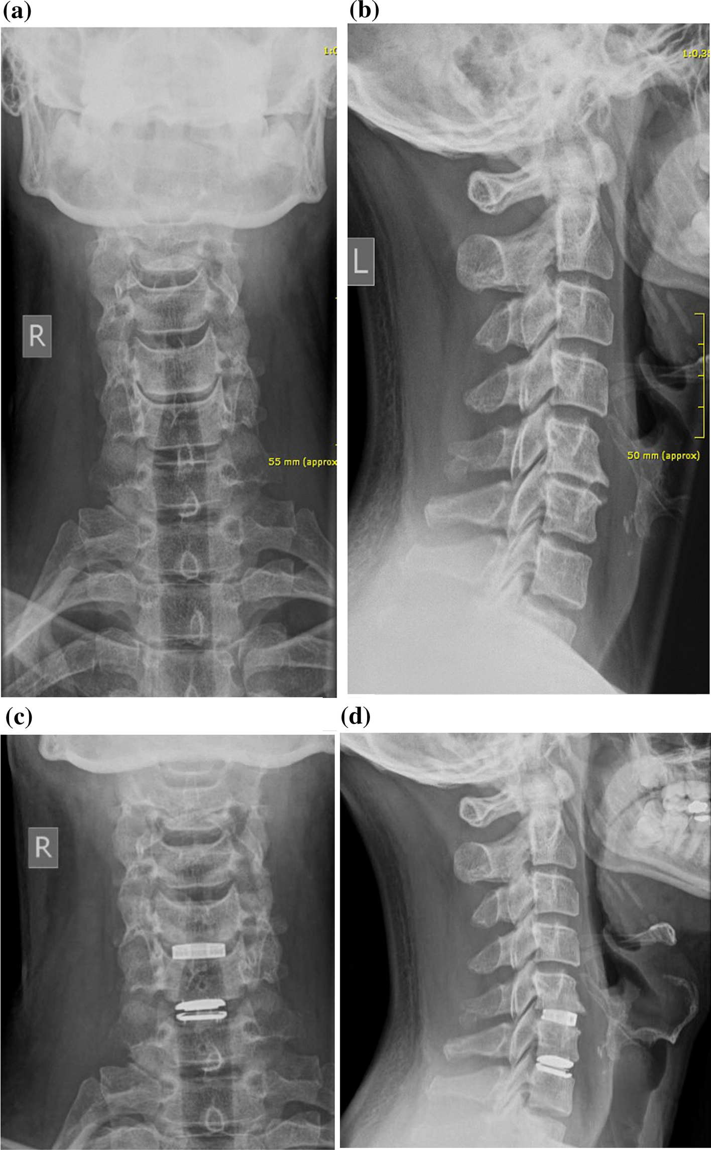 Could the different surgical goals of fusion and non-fusion also be achieved in combination within the same patient? Clinical and radiological outcome of hybrid cervical spine surgery