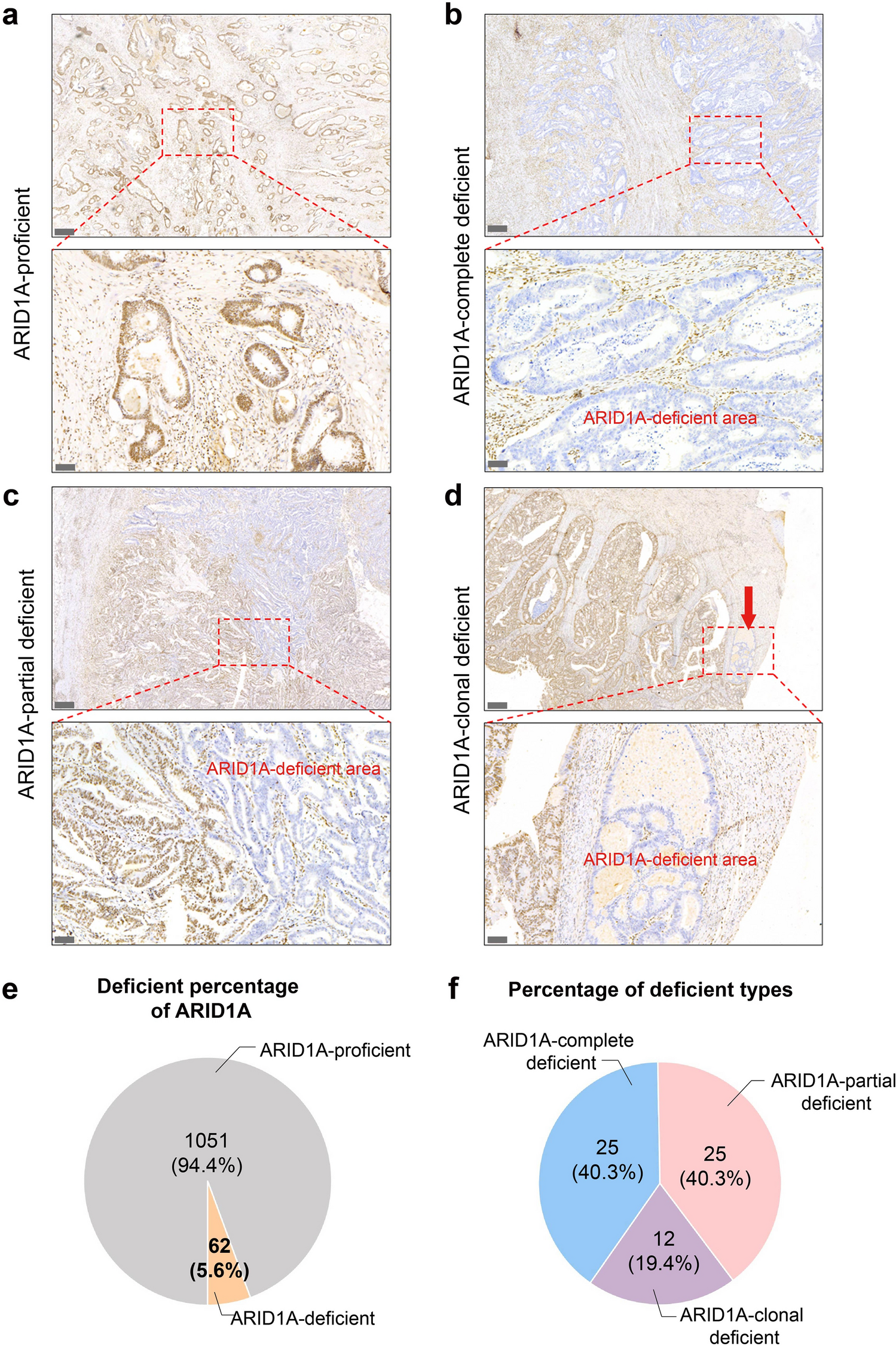 Heterogeneous expression of ARID1A in colorectal cancer indicates distinguish immune landscape and efficacy of immunotherapy