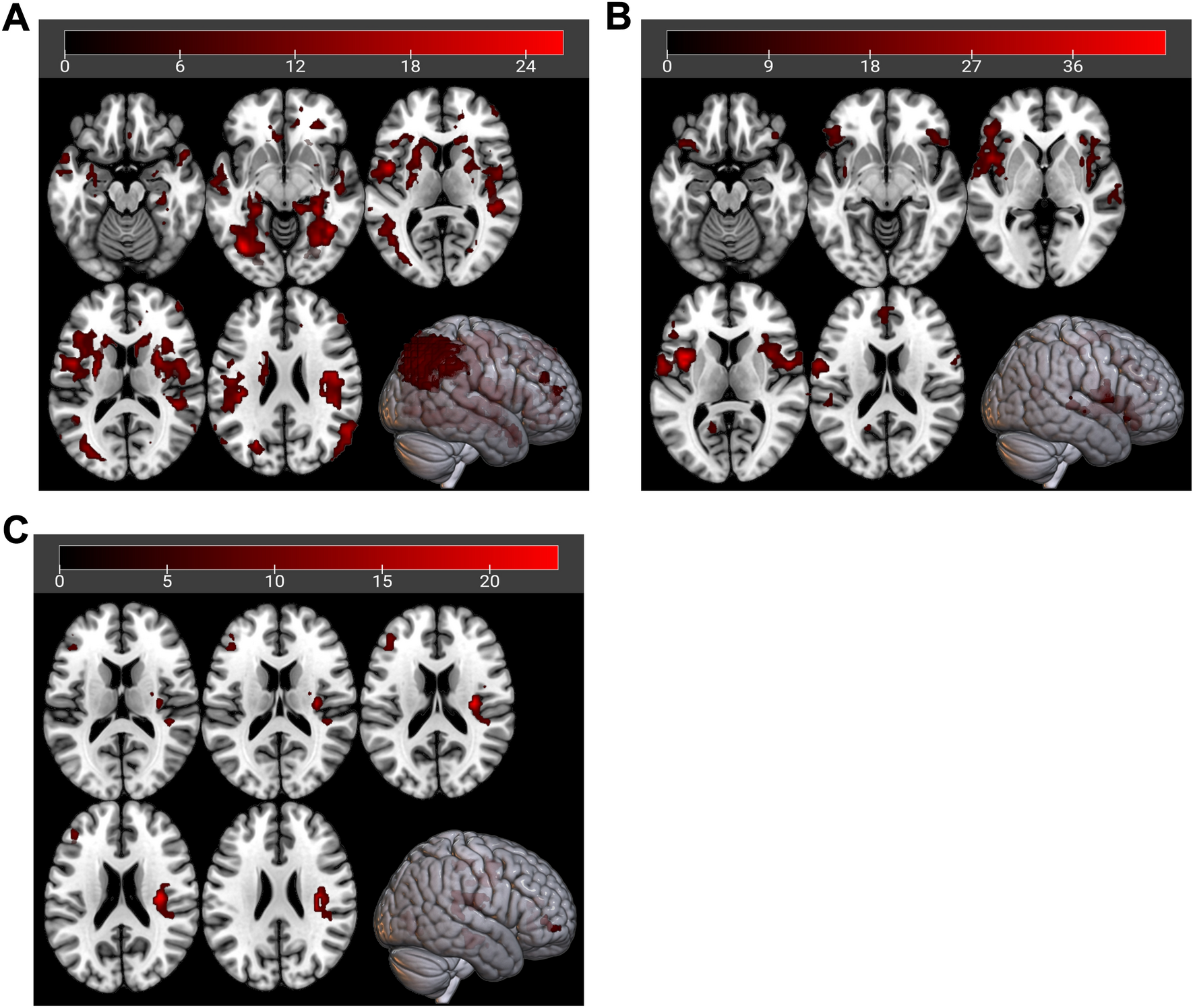Sex differences in anhedonia in bipolar depression: a resting-state fMRI study
