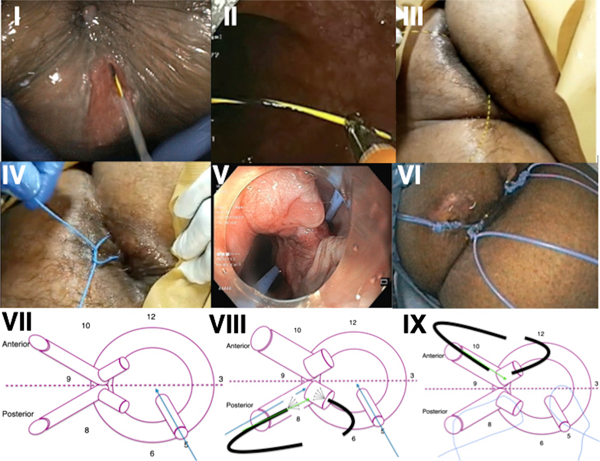 Endoscopic seton placement for inflammatory bowel disease (IBD) and non-IBD, simple or complex fistula: A pilot prospective study (with video)