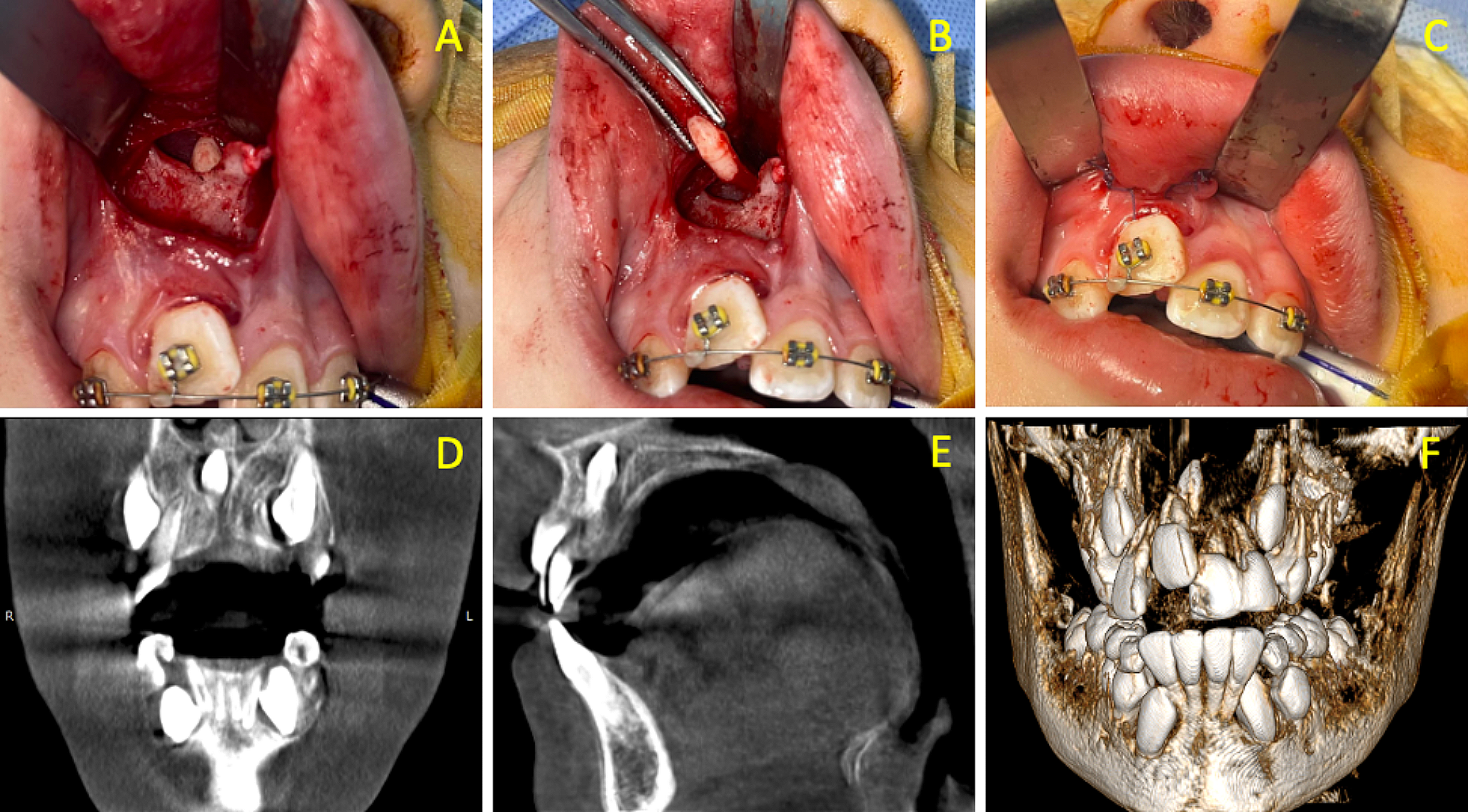 Minimally invasive intraoral removal of mesiodens via a transnasal, non-endoscopic approach: a systematic review on the purpose of 10 cases