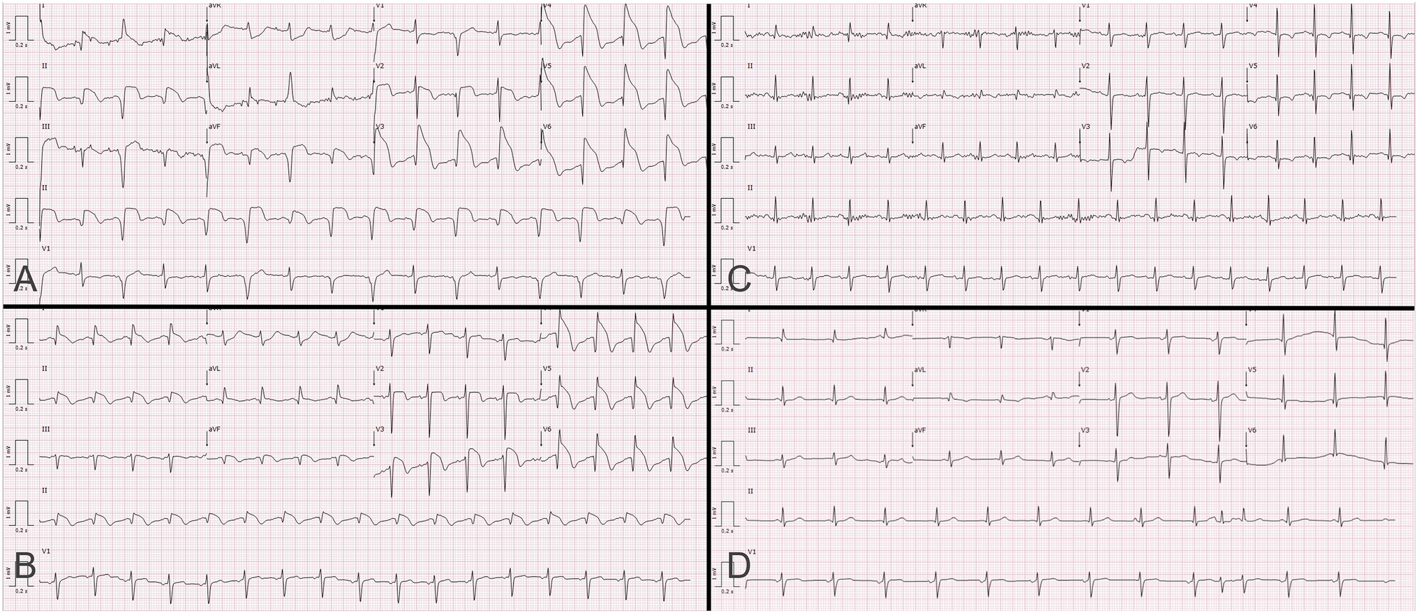“Shark Fin” electrocardiogram pattern in Takotsubo cardiomyopathy