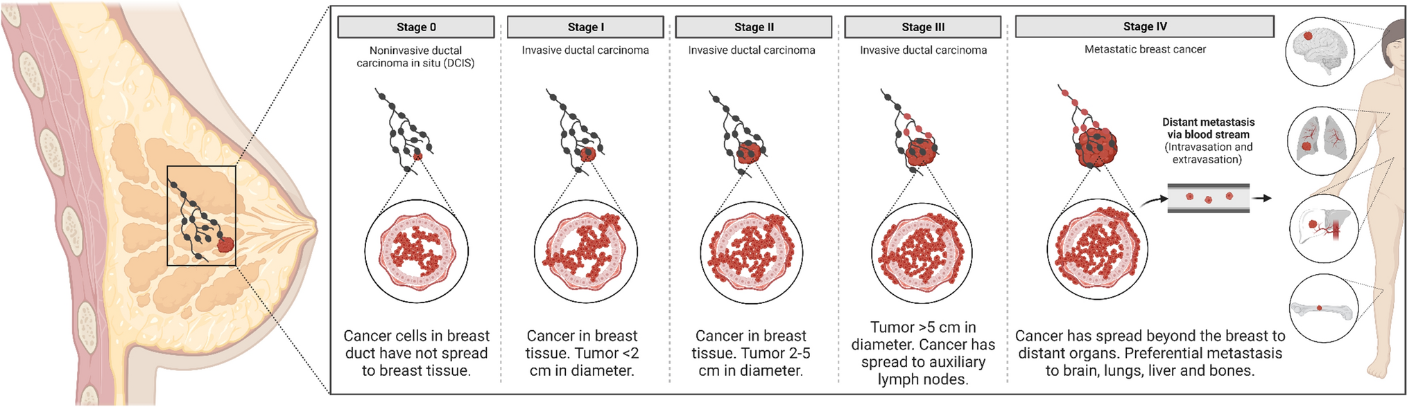 Circulating tumor cells clusters and their role in Breast cancer metastasis; a review of literature