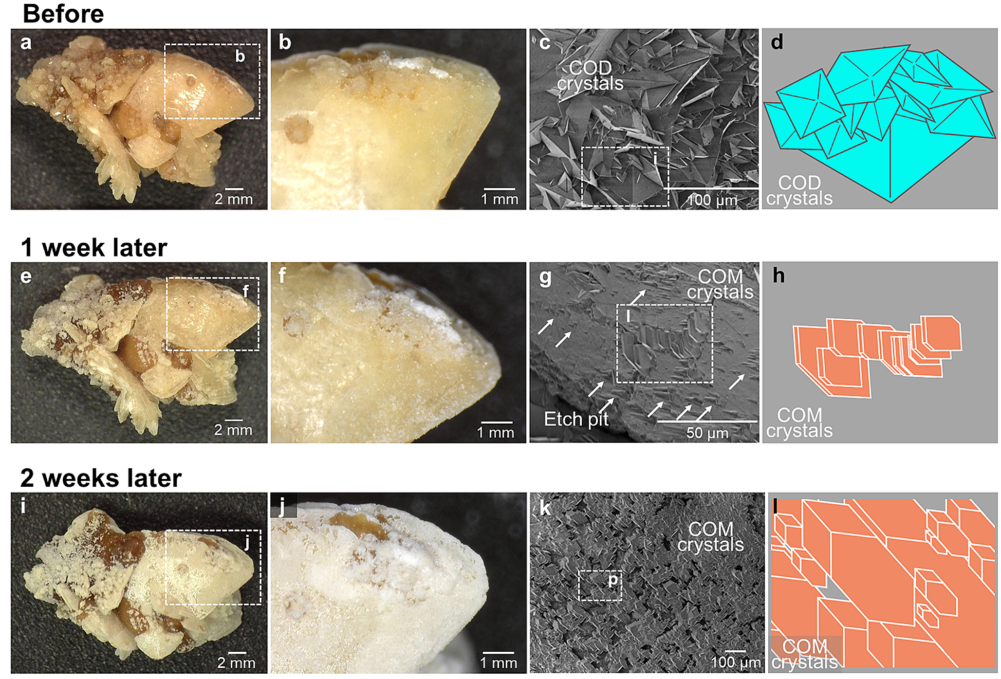 The impact of crystal phase transition on the hardness and structure of kidney stones