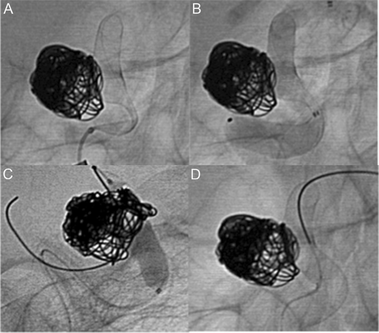 Midterm follow-up after embolization of intracranial aneurysms proximal to the circle of Willis with the Silk Vista flow diverter: the I-MAMA registry