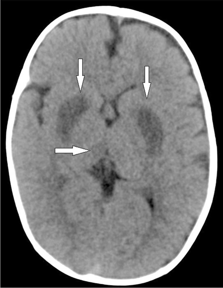 The role of CT brain findings in the early diagnosis of infantile encephalitic beriberi