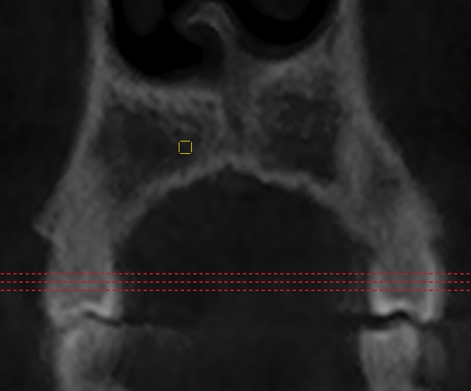The current overview of the devices of temporary anchorage placed on the palatal bone: CBCT study