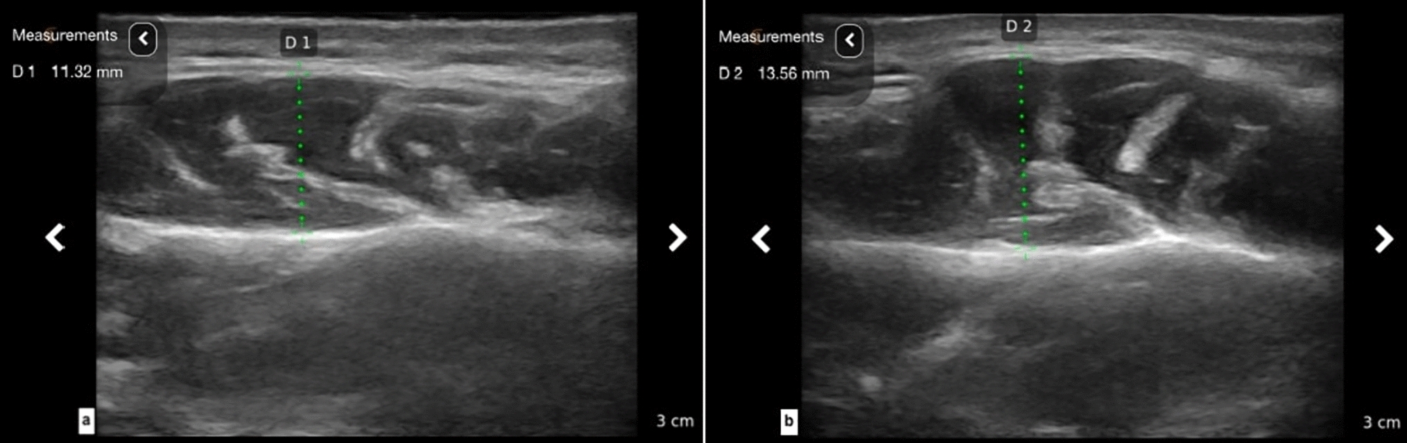 Evaluatıon of the thıckness of mastıcatory muscles ın patıents wıth chronıc perıodontıtıs by ultrasonography