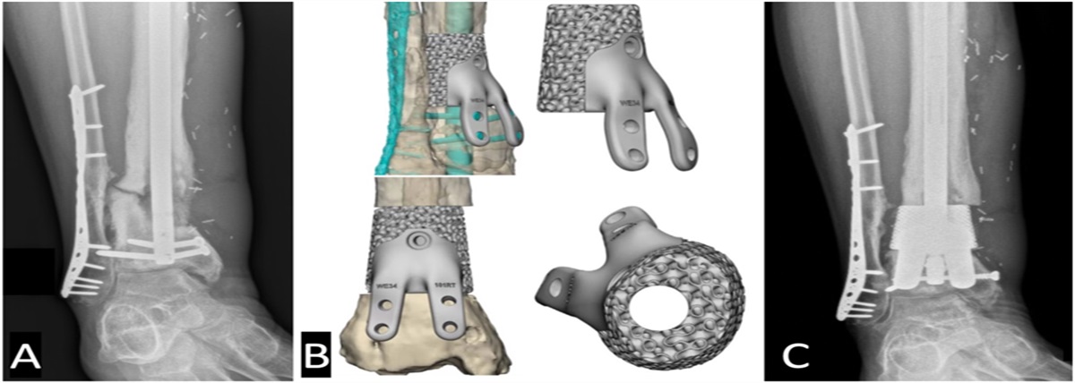 Perioperative Considerations for Use of Custom Metallic Implants in Limb Reconstruction