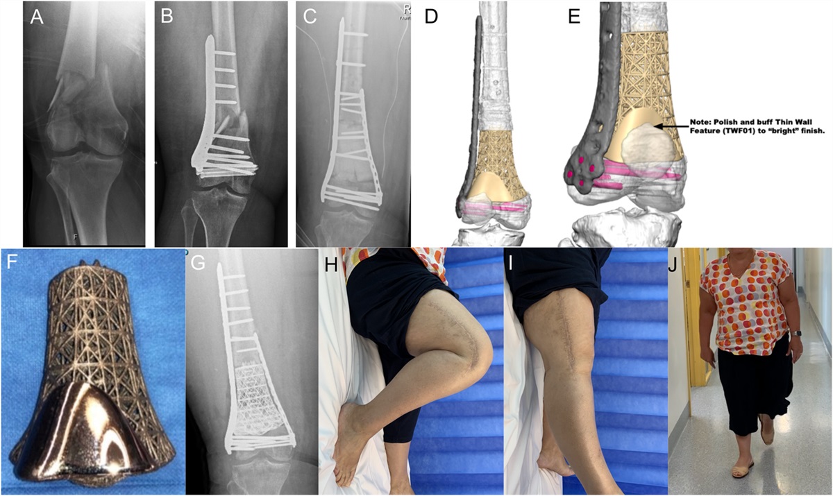 Indications for Nonbiological Reconstruction of Posttraumatic Bone Defects About the Knee