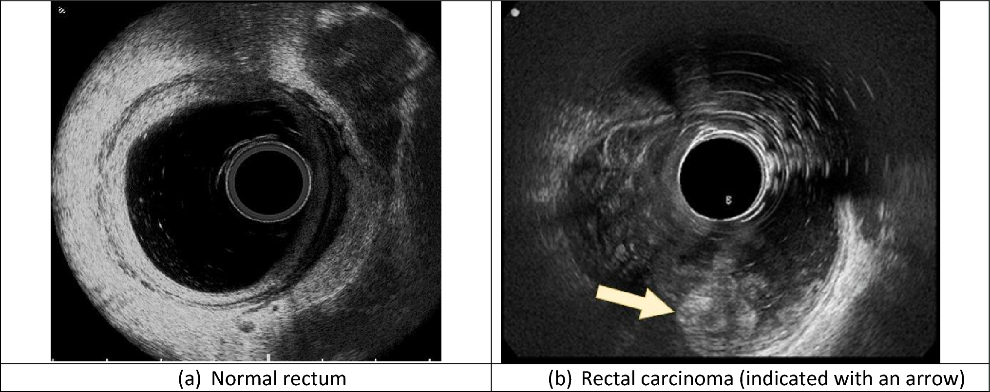 Convolutional neural network deep learning model accurately detects rectal cancer in endoanal ultrasounds