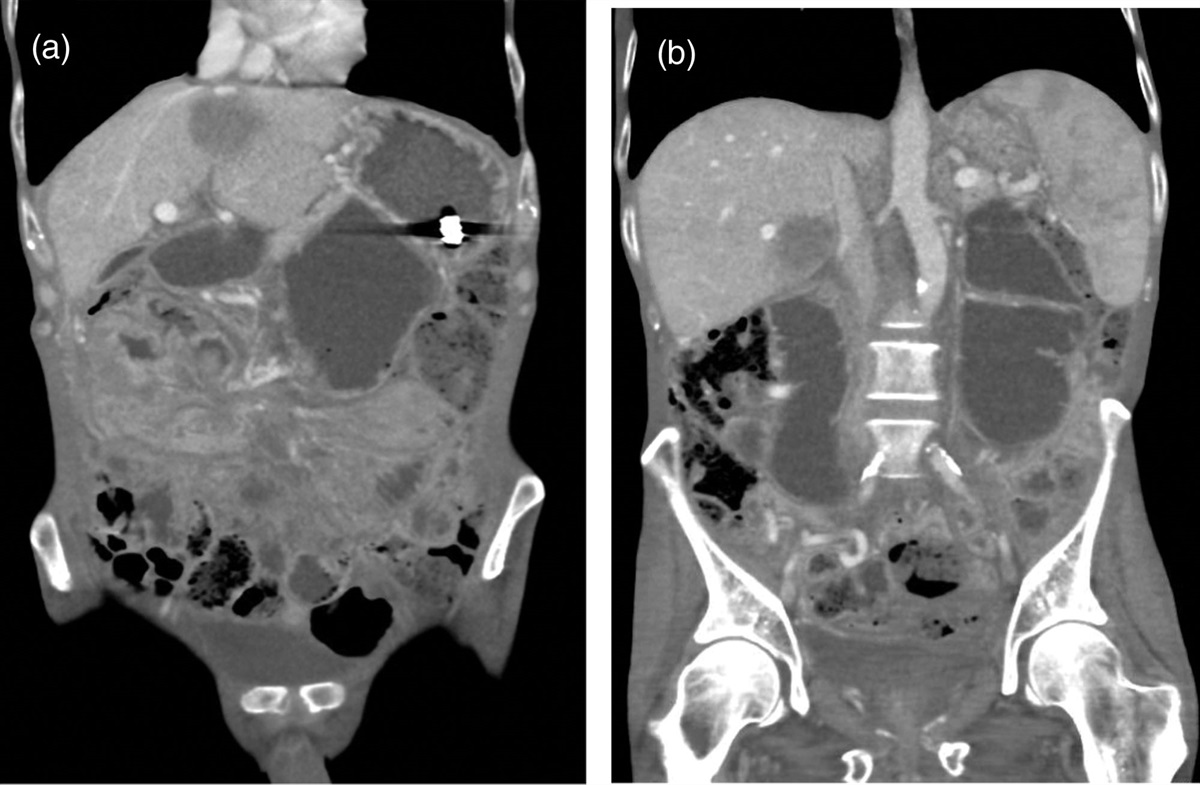 Paraneoplastic gastrointestinal dysmotility due to non-Hodgkin diffuse large B cell lymphoma: a case report