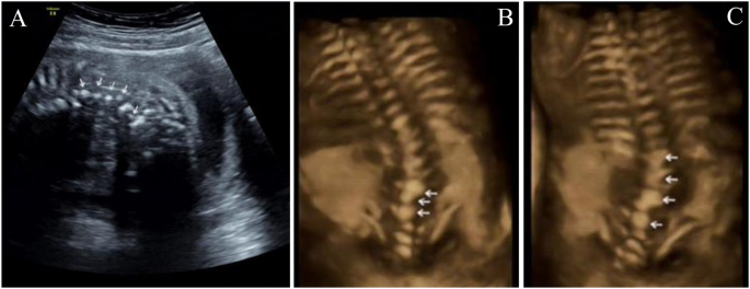Identification of a novel LFNG variant in a Chinese fetus with spondylocostal dysostosis and a systematic review