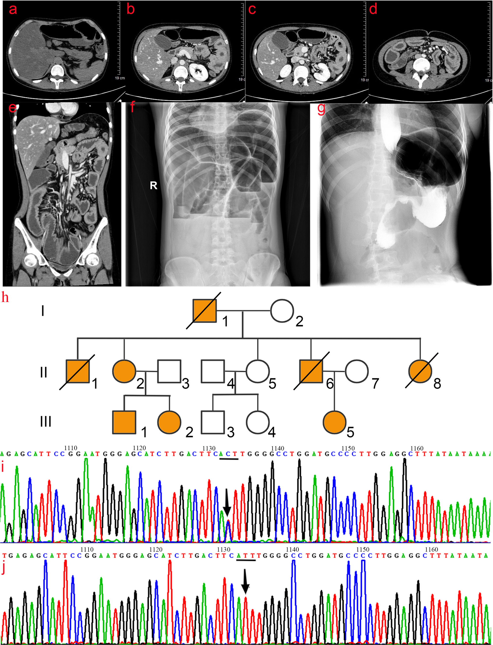 Pedigree Analysis of Nonclassical Cholesteryl Ester Storage Disease with Dominant Inheritance in a LIPA I378T Heterozygous Carrier