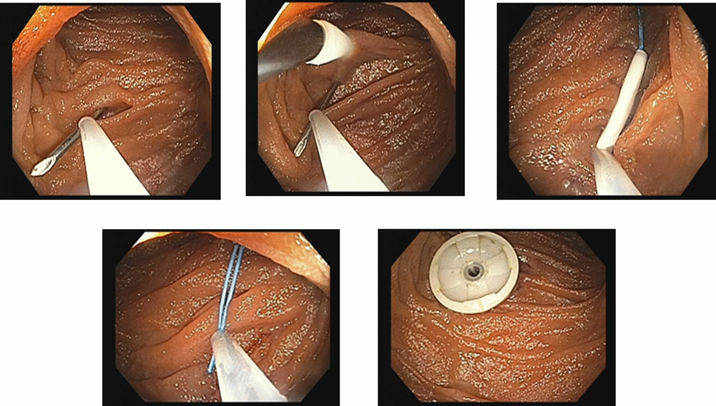 Top Tips for Direct Percutaneous Endoscopic Jejunostomy (DPEJ) Tube Placement