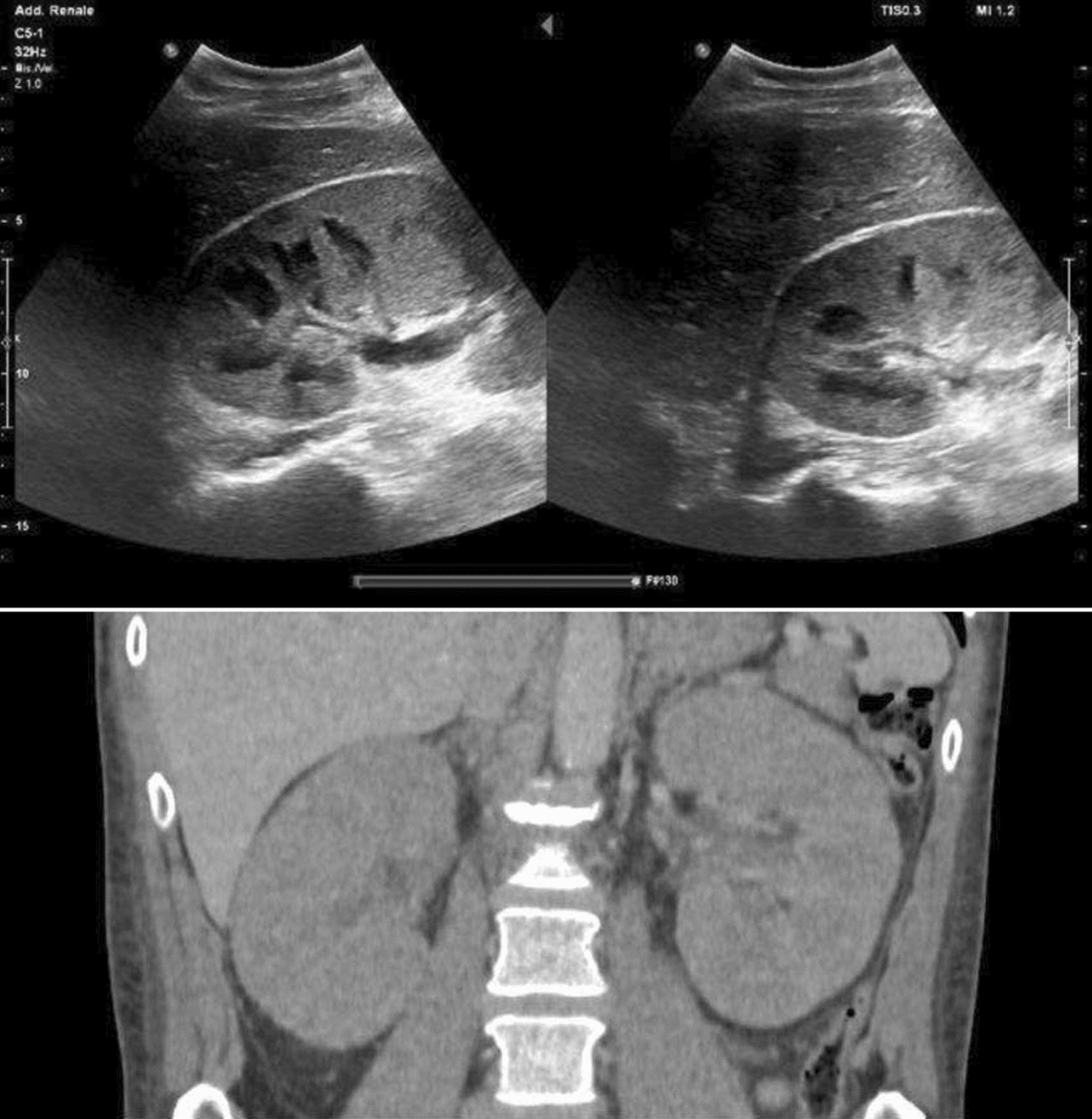Acute kidney injury and bilateral renal enlargement: a sonography matter