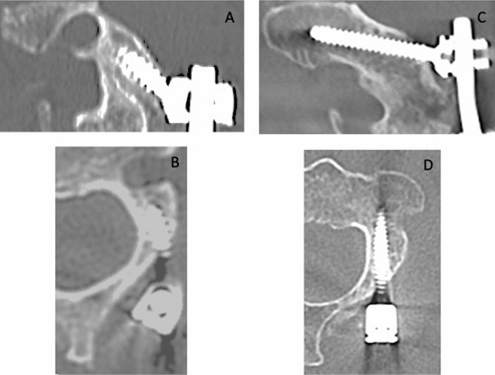 The effect of C2 screw type on perioperative outcomes and long-term stability after C2–T2 posterior cervical decompression and fusion