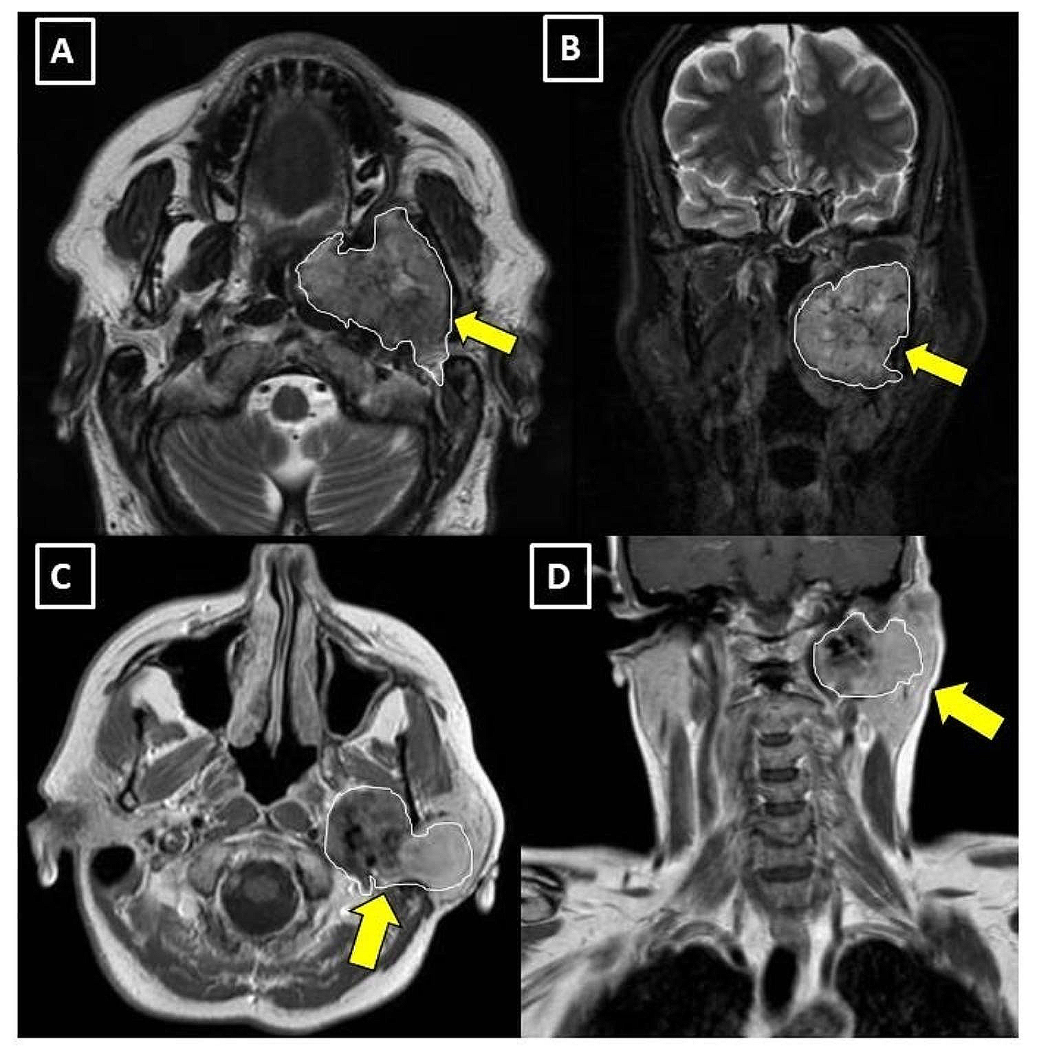 Solitary fibrous tumor of the parapharyngeal space: report of 2 cases and a literature review