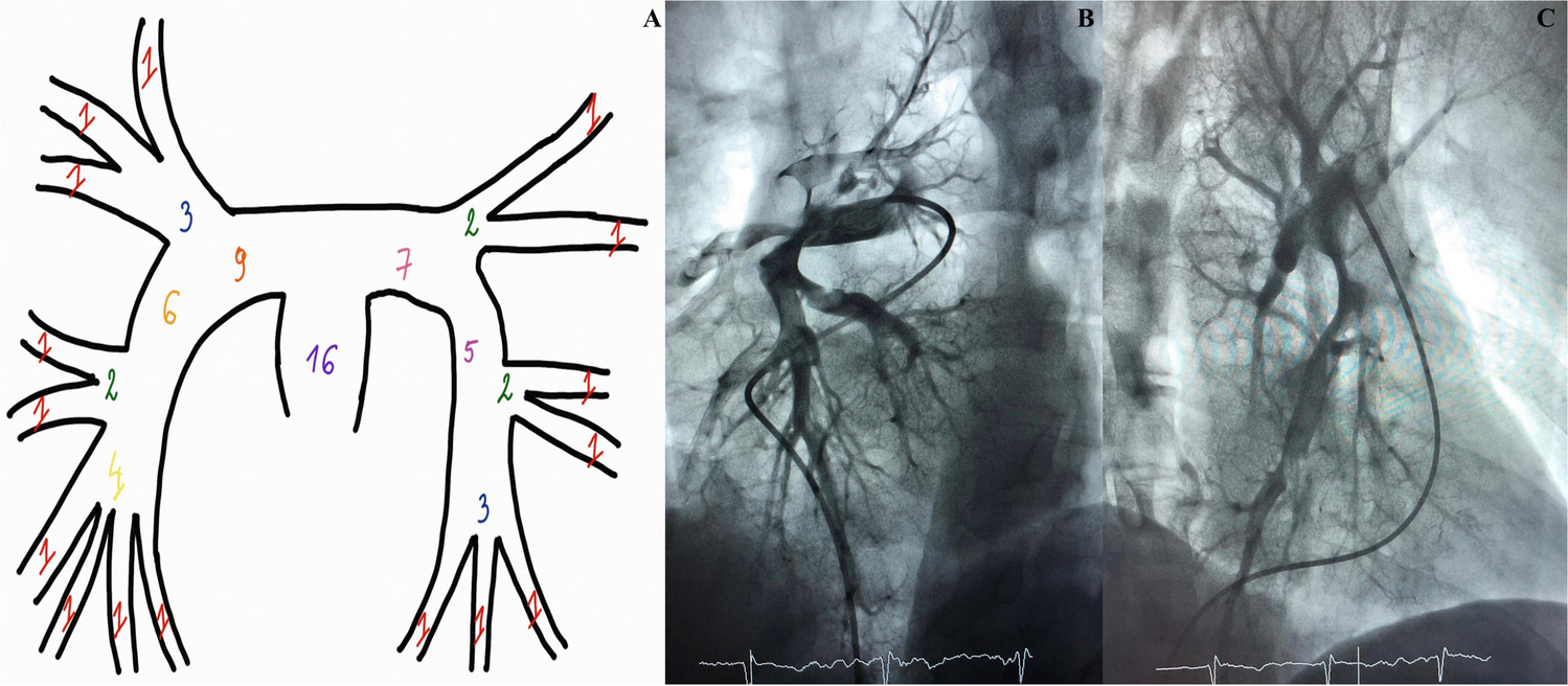 Outcomes With Hybrid Catheter-Directed Therapy Compared With Aspiration Thrombectomy for Patients With Intermediate-High Risk Pulmonary Embolism