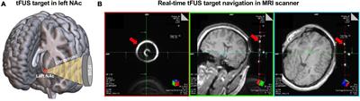 Non-invasive suppression of the human nucleus accumbens (NAc) with transcranial focused ultrasound (tFUS) modulates the reward network: a pilot study