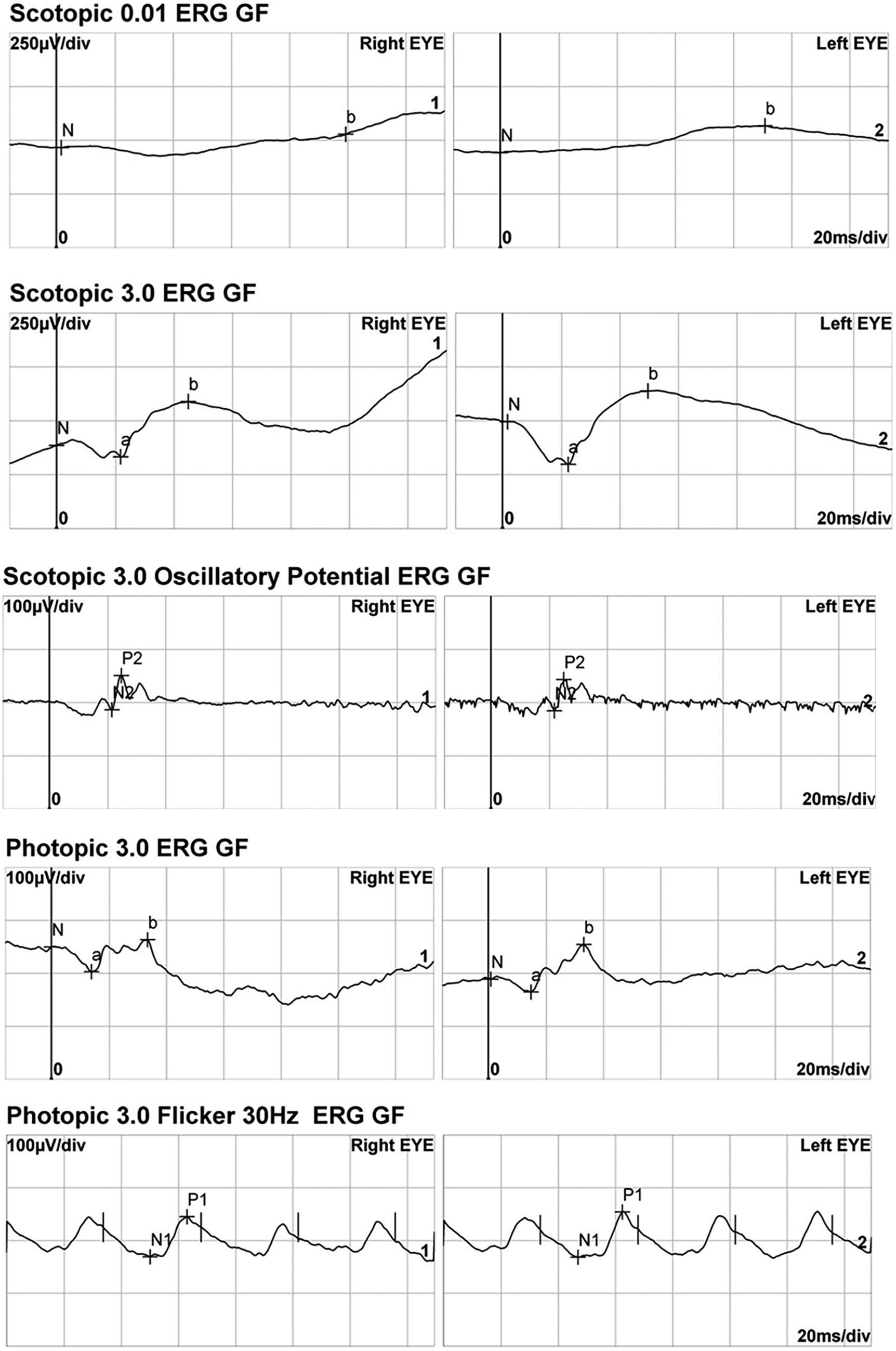 Electroretinography in congenital nystagmus patients with a normal fundus examination