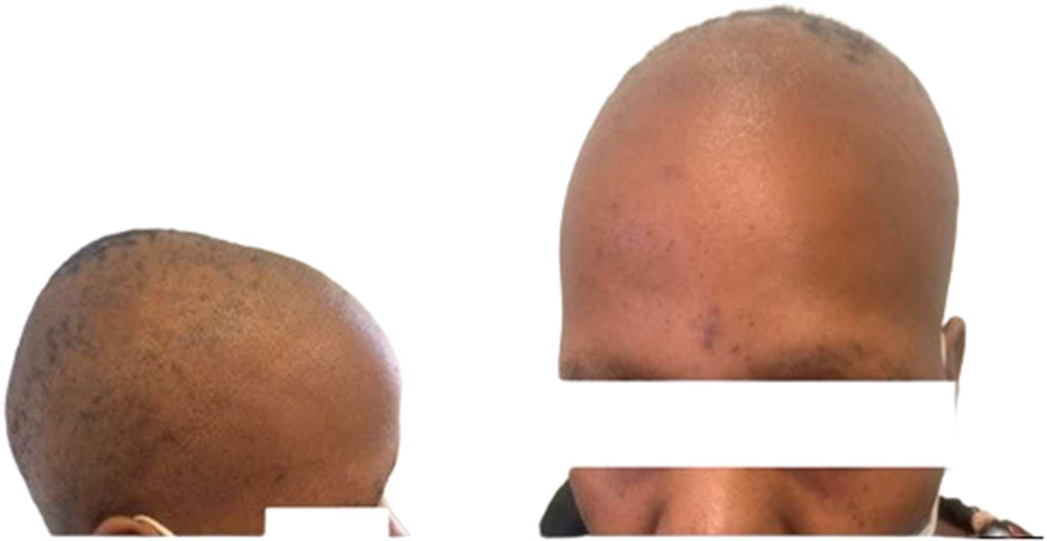 Secondary syphilis presenting with alopecia and leukoderma in a stable HIV-positive patient in a resource-limited setting: a case report