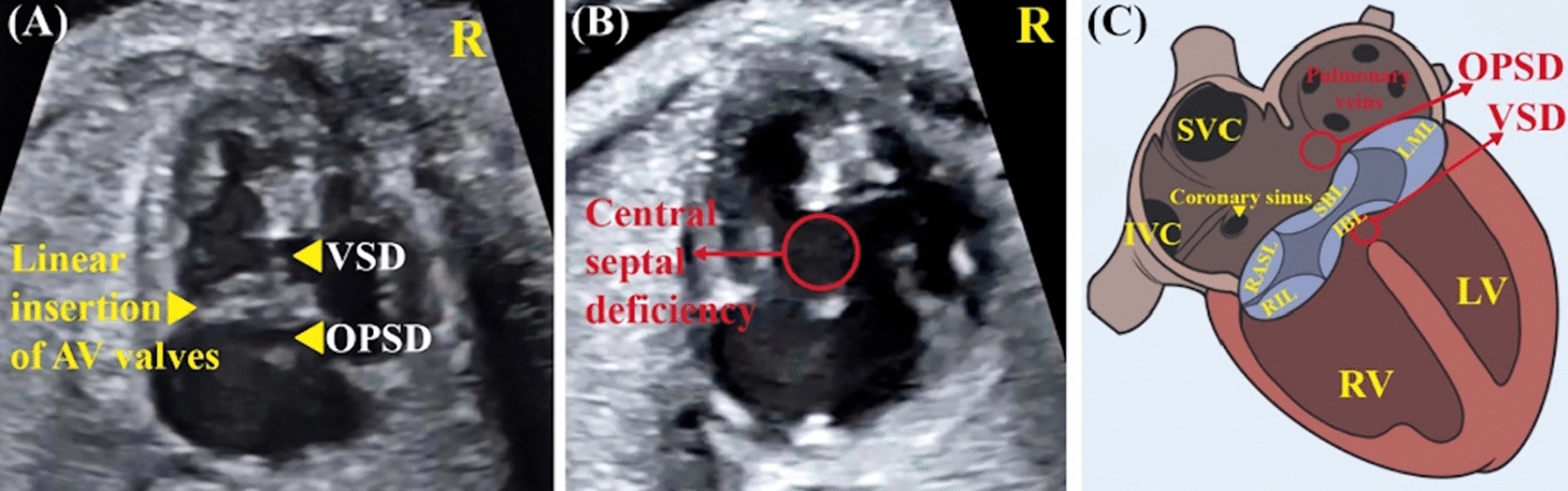 Revisiting Atrioventricular Septal Defects: Exploring Chromosomal Abnormalities, Cardiac and Extracardiac Anomalies in a Contemporary Prenatal Cohort