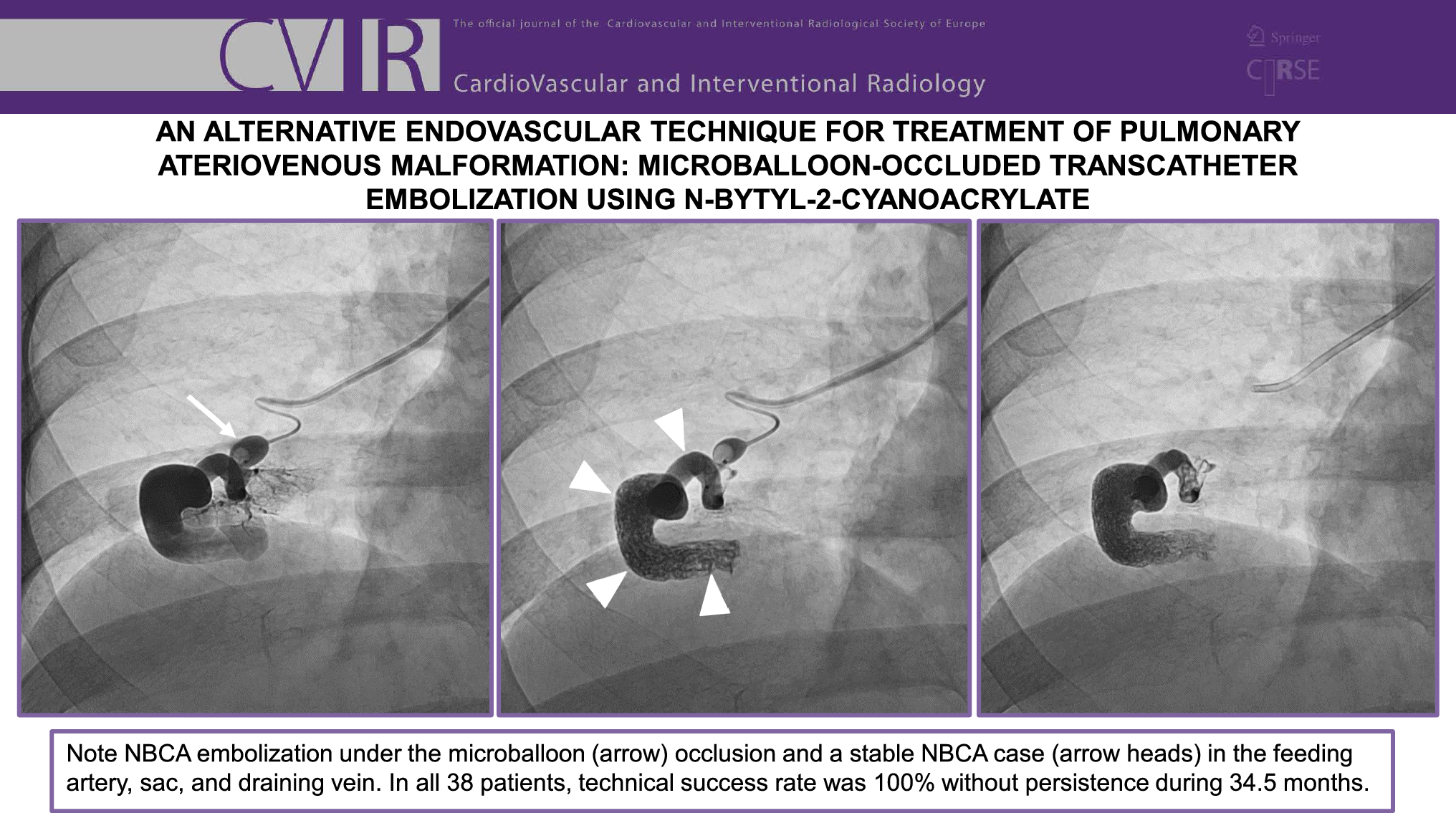 An Alternative Endovascular Technique for Treatment of Pulmonary Arteriovenous Malformation: Microballoon-occluded Transcatheter Embolization Using n-butyl-2-cyanoacrylate