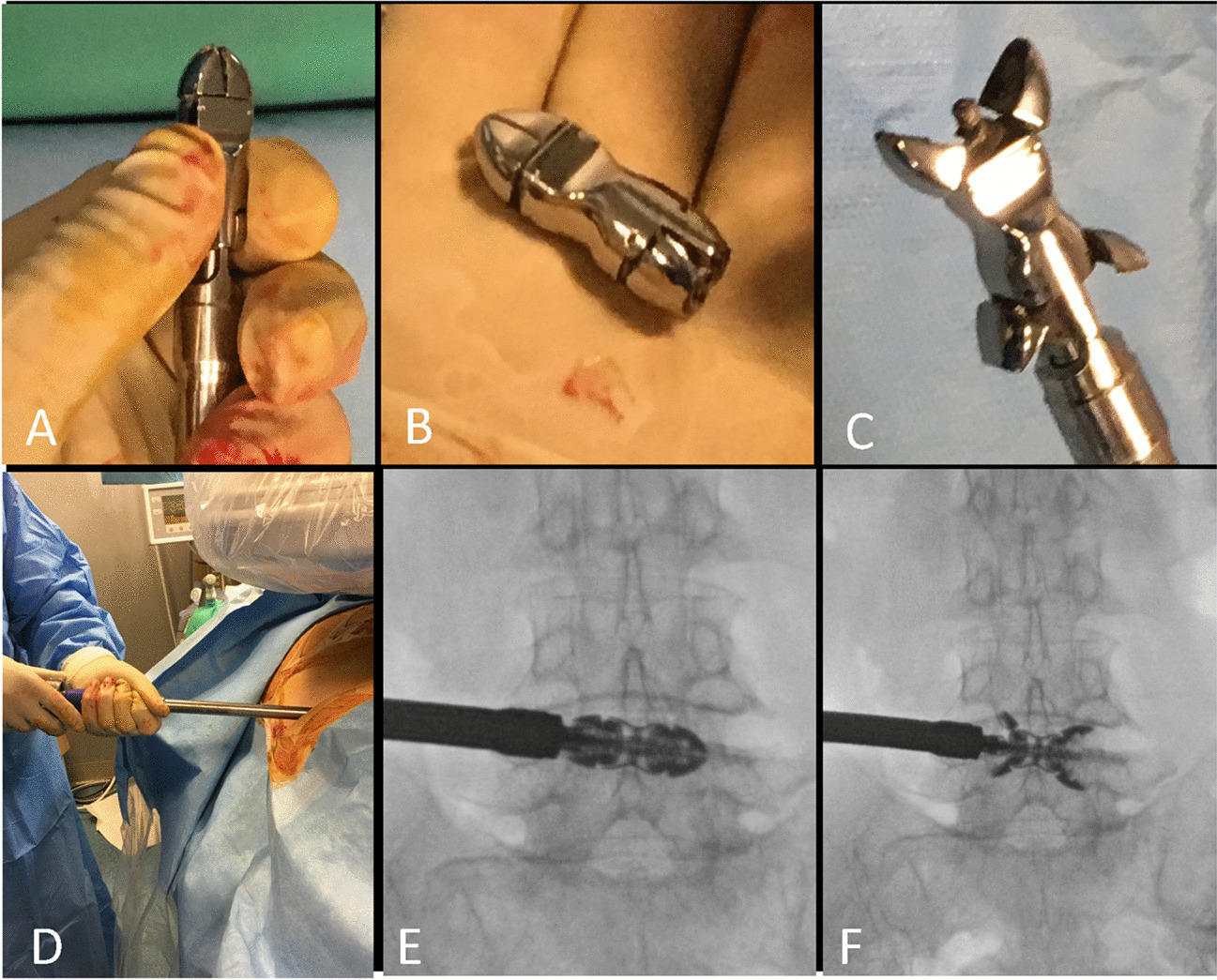 Feasibility, safety, and efficacy of a new percutaneous interspinous device: a retrospective multicenter study