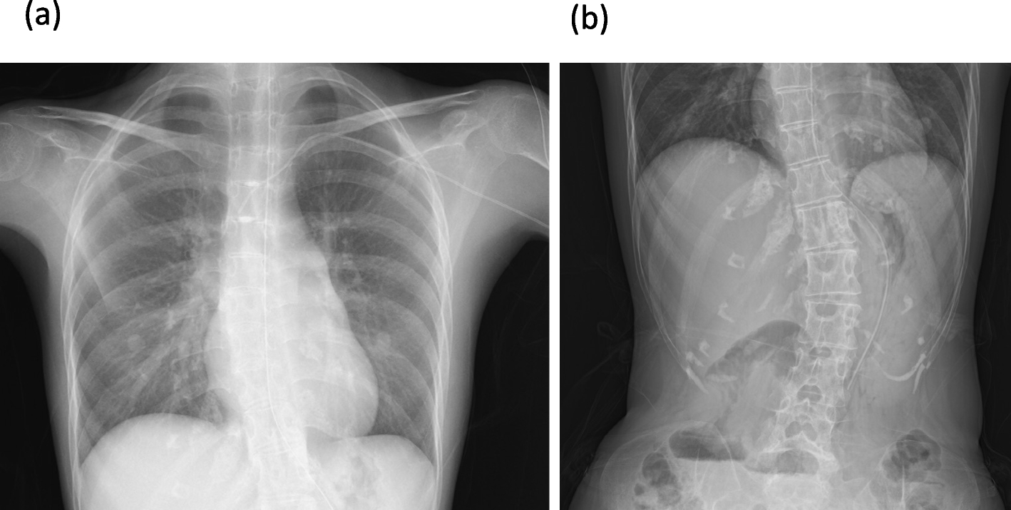 Anesthesia experience in an adult Silver-Russell syndrome: a case report