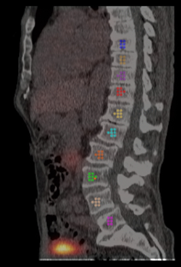 Bone marrow dosimetry in low volume mHSPC patients receiving Lu-177-PSMA therapy using SPECT/CT