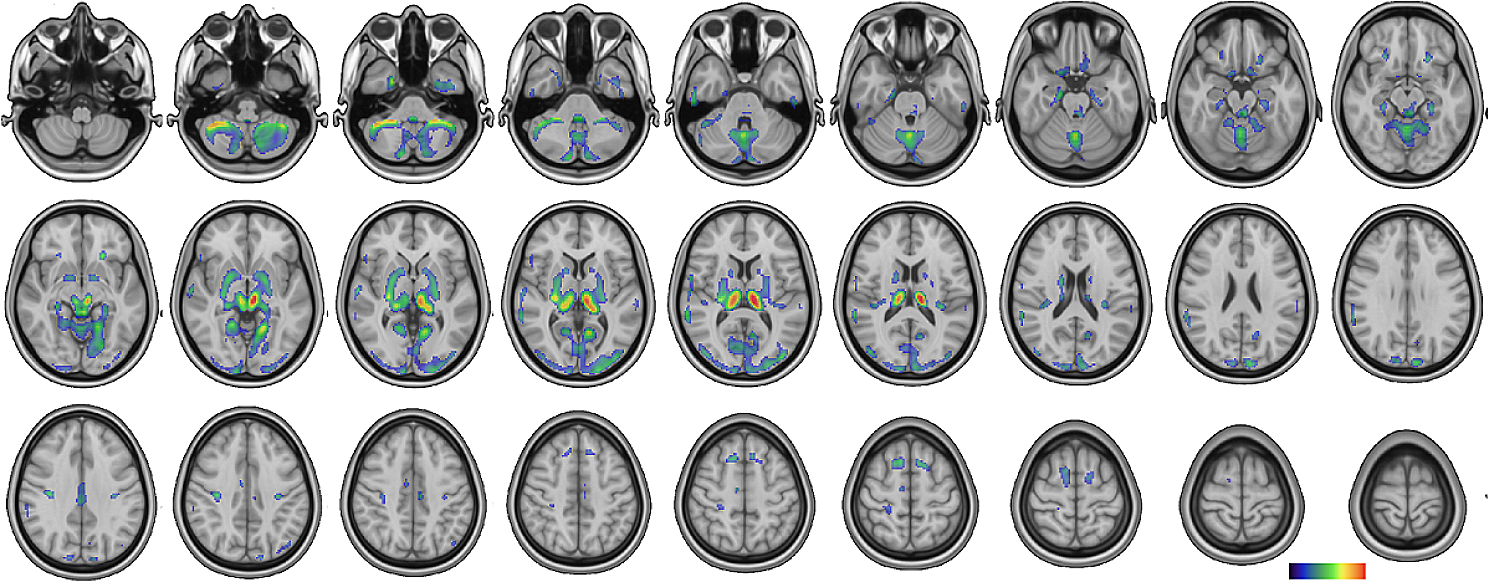 Brain 18 F-FDG PET reveals cortico-subcortical hypermetabolic dysfunction in juvenile neuropsychiatric systemic lupus erythematosus